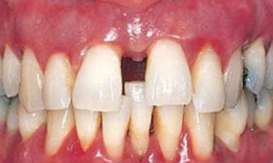 Pyorrhea Is Gum Disease We All Should Know About - Destination